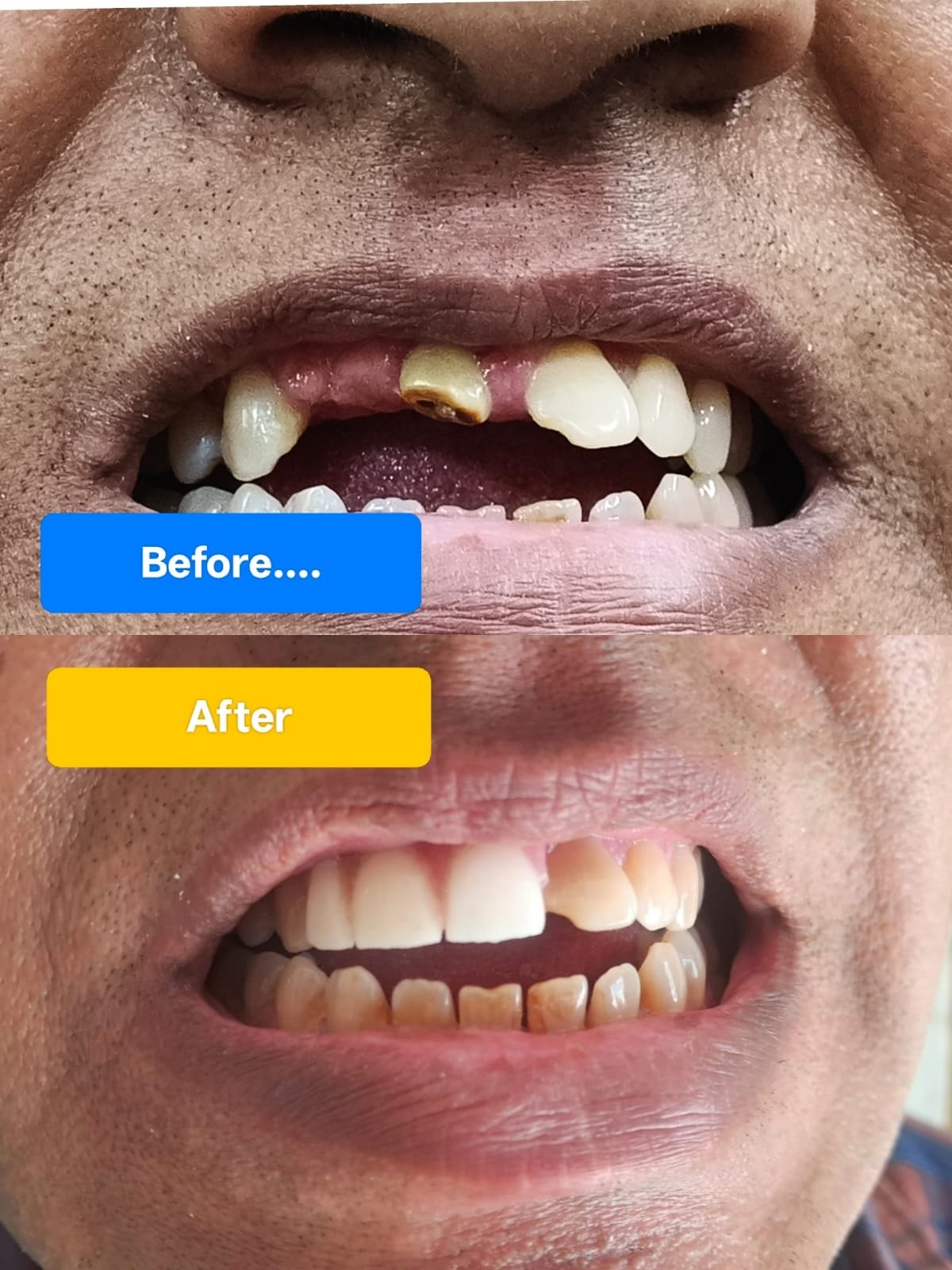 Before and after dental treatment at Wisdom Dental & Maxillofacial Centre