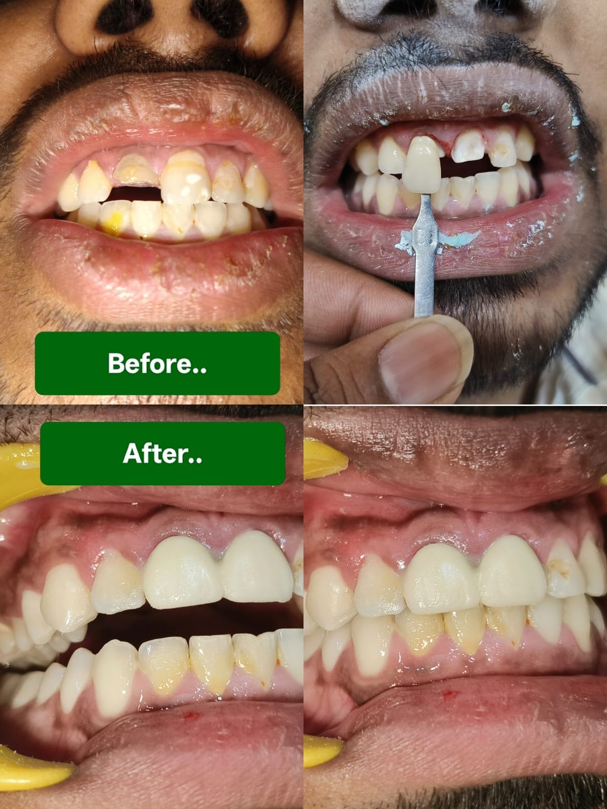Before and after dental restoration at Wisdom Dental & Maxillofacial Centre
