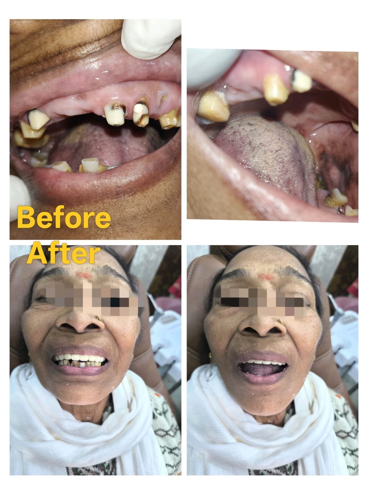 Full mouth rehabilitation before and after at Wisdom Dental & Maxillofacial Centre