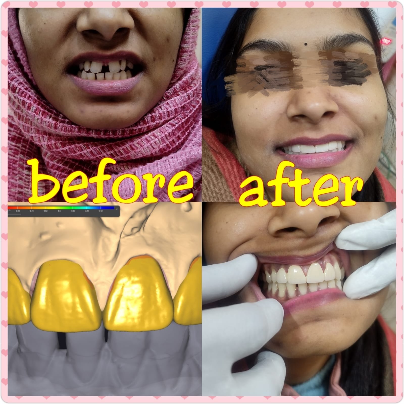 Smile makeover before and after at Wisdom Dental & Maxillofacial Centre